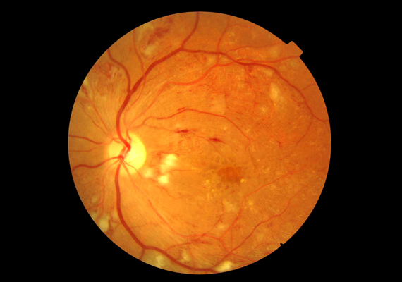 Atlas cystoid macular oedema